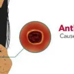 Anthrax Disease: Causes, Symptoms, and Prevention Measures 4 Anthrax Disease