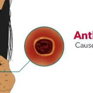 Anthrax Disease